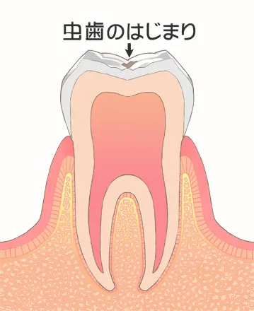 初期むし歯