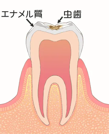 エナメル質のむし歯