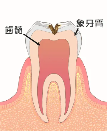 神経に近いむし歯