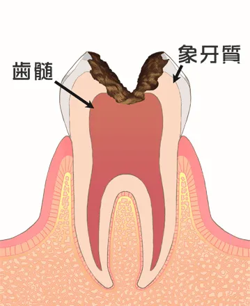 神経に達したむし歯