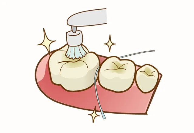 むし歯にさせないための治療