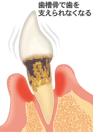 重度の歯周炎